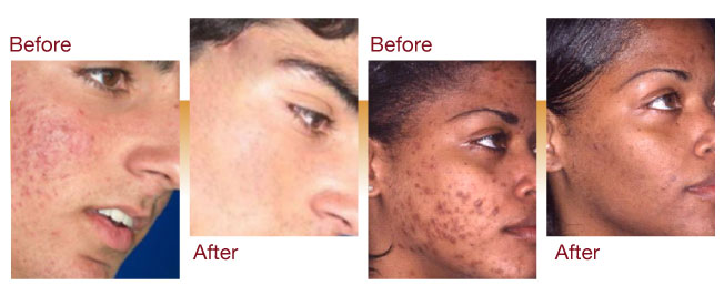 Acne Solutions