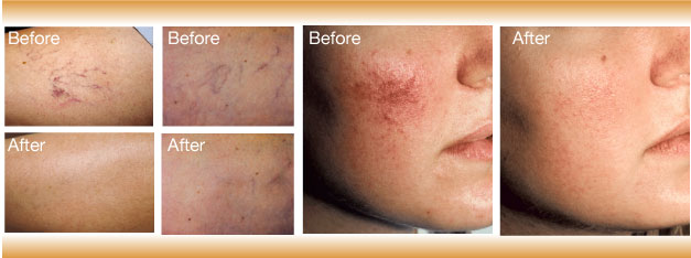 Skin Rejuvenation